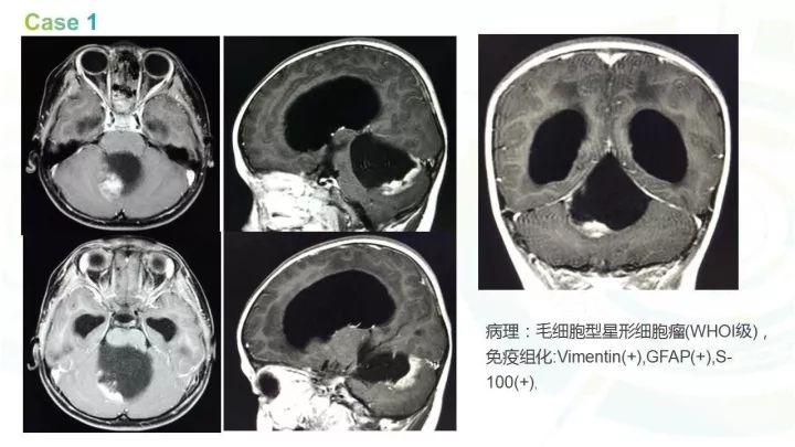 【PPT】毛细胞型星形细胞瘤MR诊断及鉴别诊断