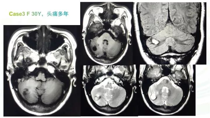 【PPT】毛细胞型星形细胞瘤MR诊断及鉴别诊断