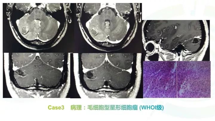 【PPT】毛细胞型星形细胞瘤MR诊断及鉴别诊断