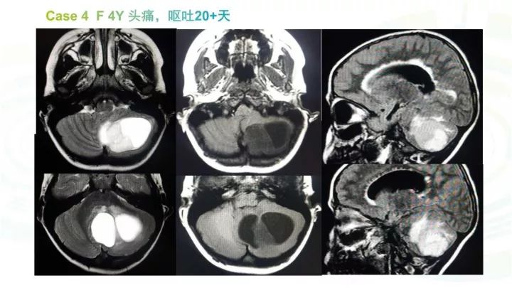 【PPT】毛细胞型星形细胞瘤MR诊断及鉴别诊断