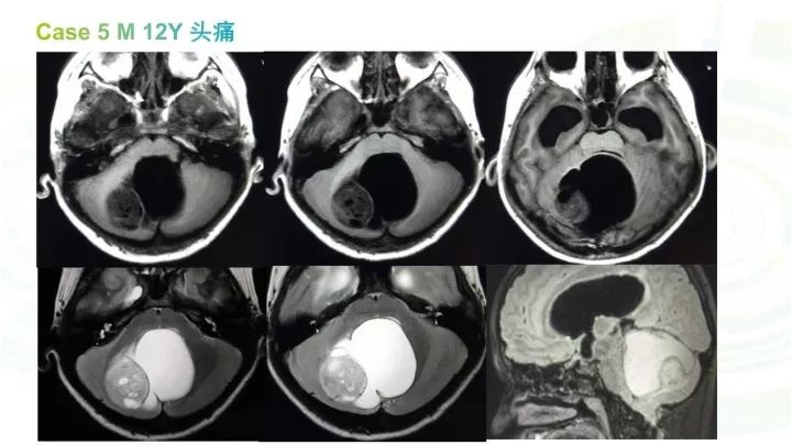 【PPT】毛细胞型星形细胞瘤MR诊断及鉴别诊断