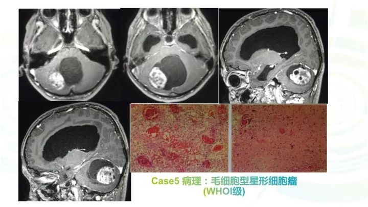【PPT】毛细胞型星形细胞瘤MR诊断及鉴别诊断