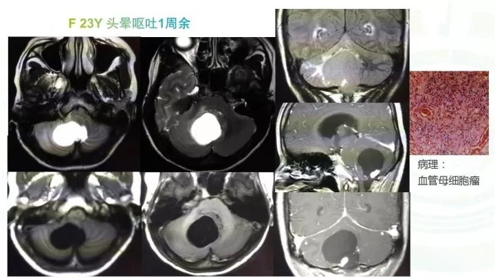 【PPT】毛细胞型星形细胞瘤MR诊断及鉴别诊断