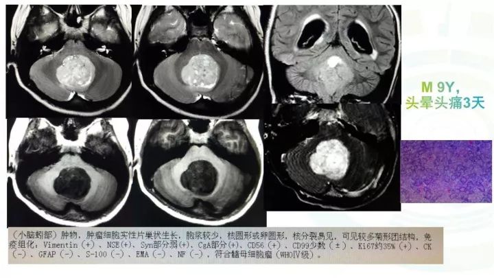【PPT】毛细胞型星形细胞瘤MR诊断及鉴别诊断