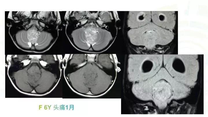【PPT】毛细胞型星形细胞瘤MR诊断及鉴别诊断