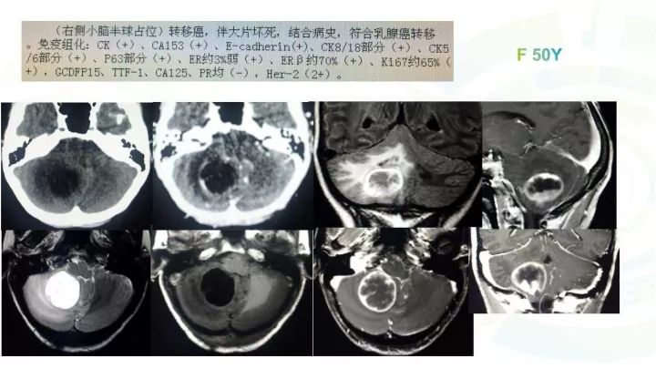 【PPT】毛细胞型星形细胞瘤MR诊断及鉴别诊断