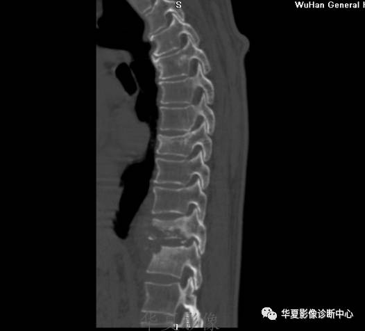 【病例】脊柱布氏杆菌病1例X线CT及MR 【病例】脊柱布氏杆菌病1例X线CT及MR