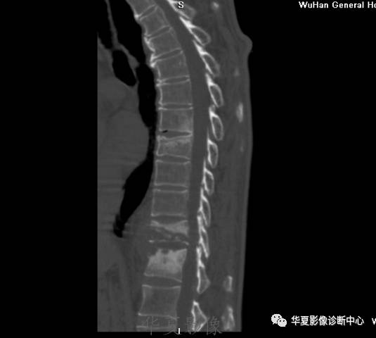 【病例】脊柱布氏杆菌病1例X线CT及MR 【病例】脊柱布氏杆菌病1例X线CT及MR