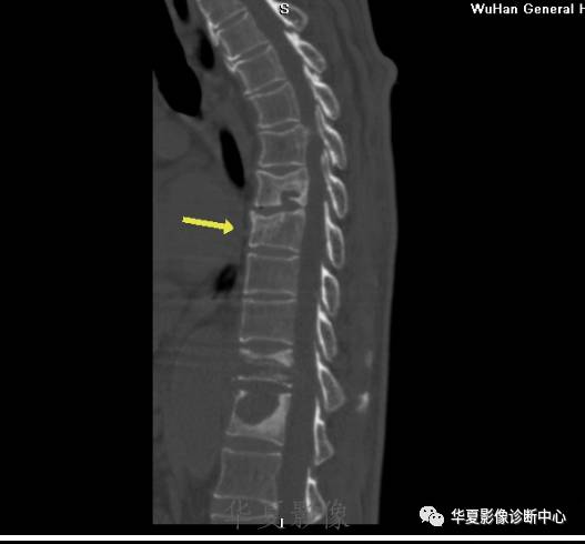 【病例】脊柱布氏杆菌病1例X线CT及MR 【病例】脊柱布氏杆菌病1例X线CT及MR