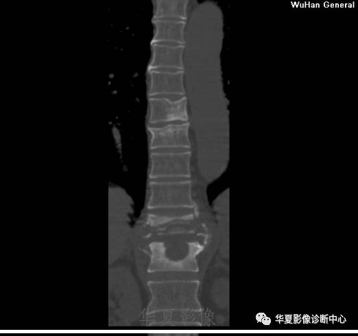 【病例】脊柱布氏杆菌病1例X线CT及MR 【病例】脊柱布氏杆菌病1例X线CT及MR