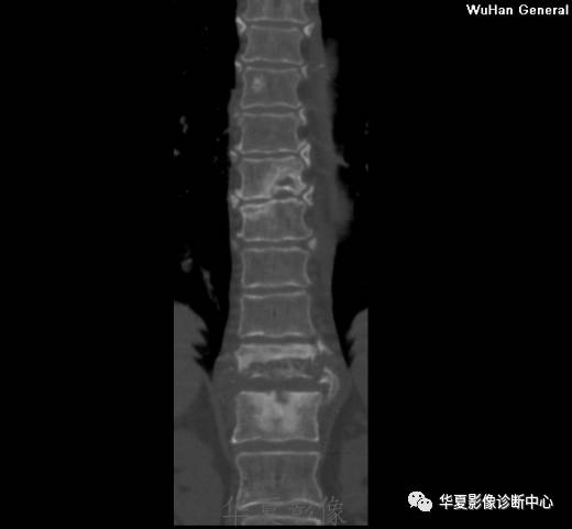 【病例】脊柱布氏杆菌病1例X线CT及MR 【病例】脊柱布氏杆菌病1例X线CT及MR