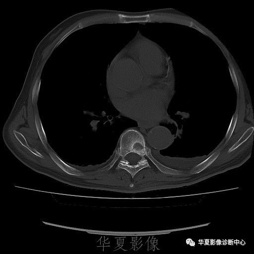 【病例】脊柱布氏杆菌病1例X线CT及MR 【病例】脊柱布氏杆菌病1例X线CT及MR