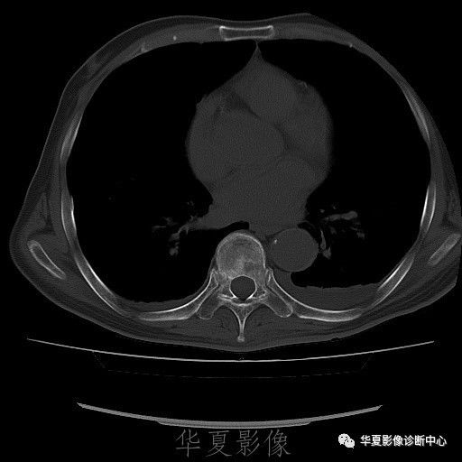 【病例】脊柱布氏杆菌病1例X线CT及MR 【病例】脊柱布氏杆菌病1例X线CT及MR