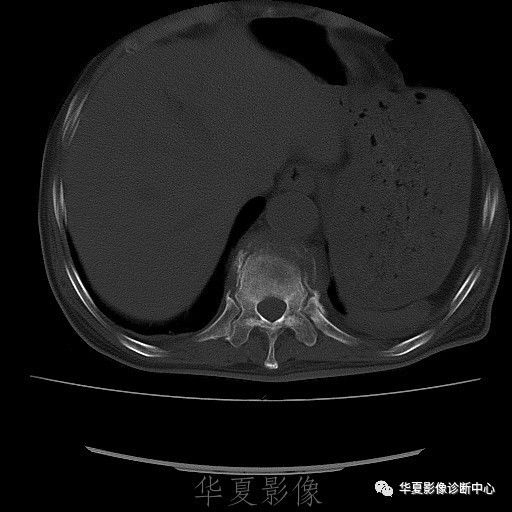 【病例】脊柱布氏杆菌病1例X线CT及MR 【病例】脊柱布氏杆菌病1例X线CT及MR