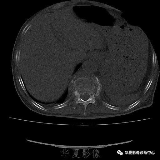 【病例】脊柱布氏杆菌病1例X线CT及MR 【病例】脊柱布氏杆菌病1例X线CT及MR