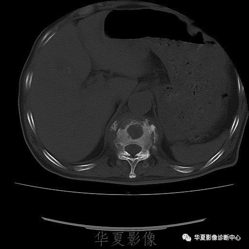 【病例】脊柱布氏杆菌病1例X线CT及MR 【病例】脊柱布氏杆菌病1例X线CT及MR