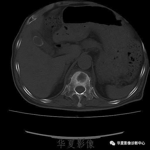 【病例】脊柱布氏杆菌病1例X线CT及MR 【病例】脊柱布氏杆菌病1例X线CT及MR