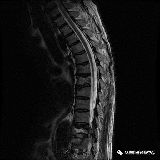 【病例】脊柱布氏杆菌病1例X线CT及MR 【病例】脊柱布氏杆菌病1例X线CT及MR
