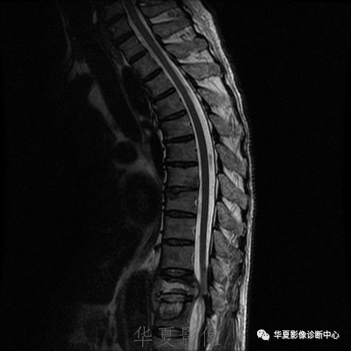 【病例】脊柱布氏杆菌病1例X线CT及MR 【病例】脊柱布氏杆菌病1例X线CT及MR
