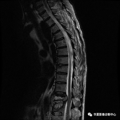 【病例】脊柱布氏杆菌病1例X线CT及MR 【病例】脊柱布氏杆菌病1例X线CT及MR