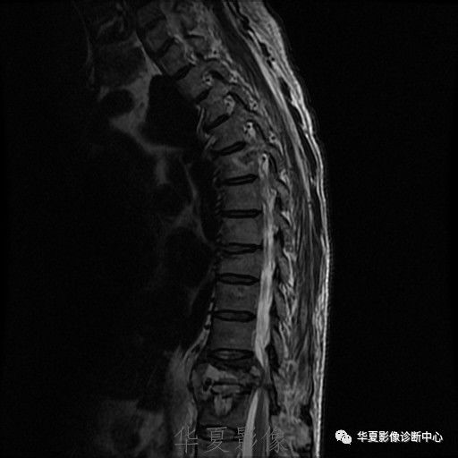 【病例】脊柱布氏杆菌病1例X线CT及MR 【病例】脊柱布氏杆菌病1例X线CT及MR