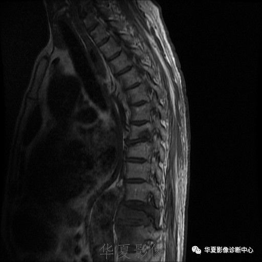 【病例】脊柱布氏杆菌病1例X线CT及MR 【病例】脊柱布氏杆菌病1例X线CT及MR