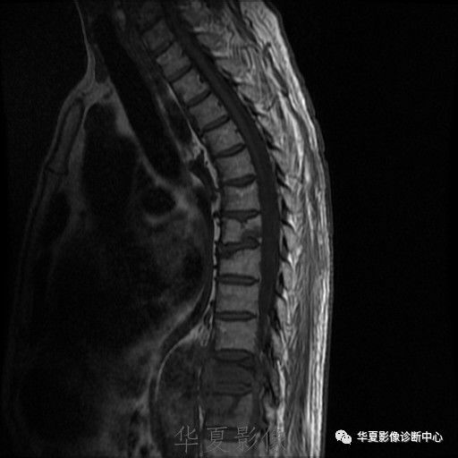 【病例】脊柱布氏杆菌病1例X线CT及MR 【病例】脊柱布氏杆菌病1例X线CT及MR