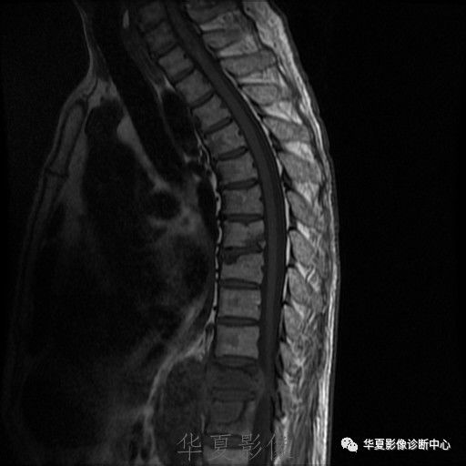 【病例】脊柱布氏杆菌病1例X线CT及MR 【病例】脊柱布氏杆菌病1例X线CT及MR