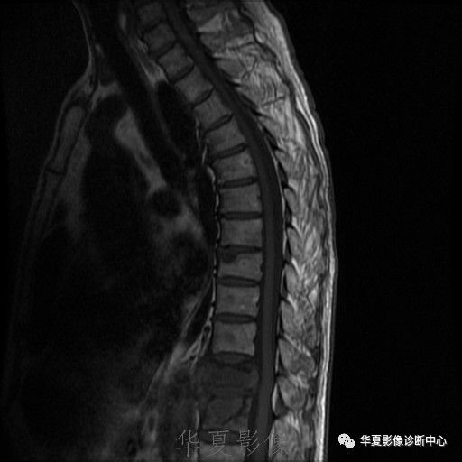 【病例】脊柱布氏杆菌病1例X线CT及MR 【病例】脊柱布氏杆菌病1例X线CT及MR