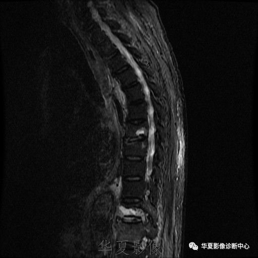 【病例】脊柱布氏杆菌病1例X线CT及MR 【病例】脊柱布氏杆菌病1例X线CT及MR