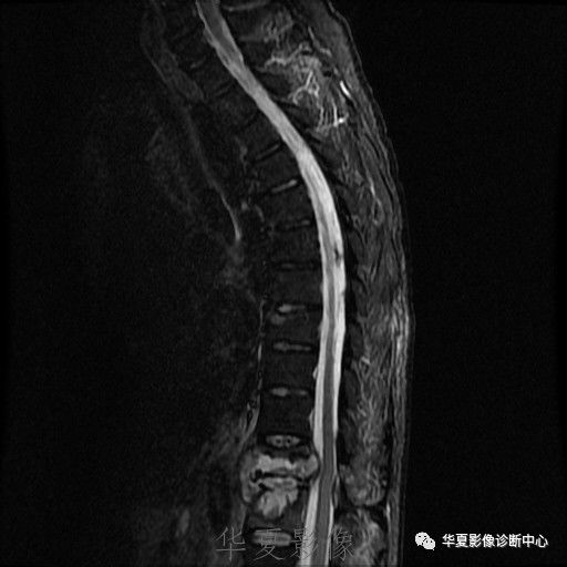 【病例】脊柱布氏杆菌病1例X线CT及MR 【病例】脊柱布氏杆菌病1例X线CT及MR