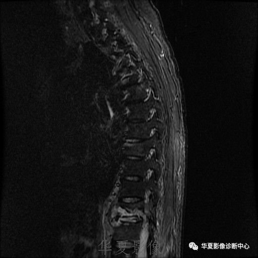 【病例】脊柱布氏杆菌病1例X线CT及MR 【病例】脊柱布氏杆菌病1例X线CT及MR