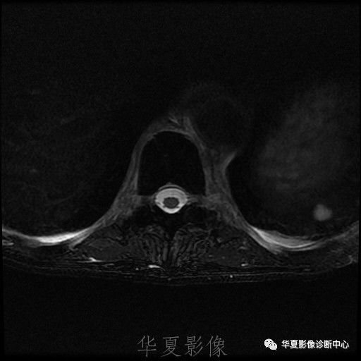 【病例】脊柱布氏杆菌病1例X线CT及MR 【病例】脊柱布氏杆菌病1例X线CT及MR