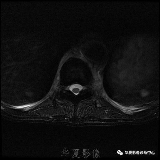 【病例】脊柱布氏杆菌病1例X线CT及MR 【病例】脊柱布氏杆菌病1例X线CT及MR