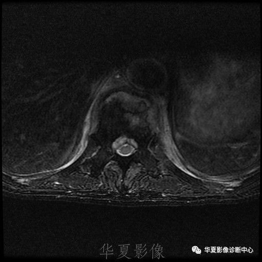 【病例】脊柱布氏杆菌病1例X线CT及MR 【病例】脊柱布氏杆菌病1例X线CT及MR