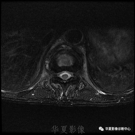 【病例】脊柱布氏杆菌病1例X线CT及MR 【病例】脊柱布氏杆菌病1例X线CT及MR