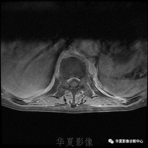 【病例】脊柱布氏杆菌病1例X线CT及MR 【病例】脊柱布氏杆菌病1例X线CT及MR