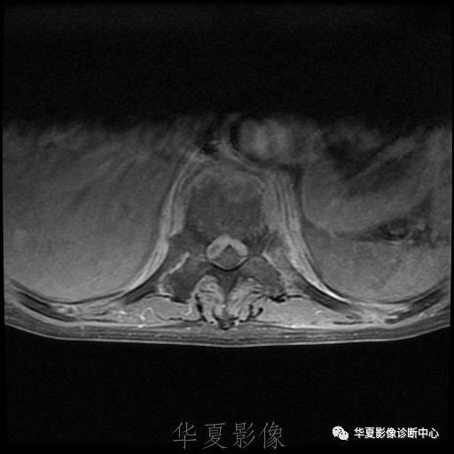 【病例】脊柱布氏杆菌病1例X线CT及MR 【病例】脊柱布氏杆菌病1例X线CT及MR