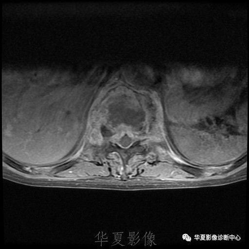 【病例】脊柱布氏杆菌病1例X线CT及MR 【病例】脊柱布氏杆菌病1例X线CT及MR
