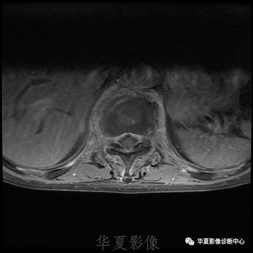 【病例】脊柱布氏杆菌病1例X线CT及MR 【病例】脊柱布氏杆菌病1例X线CT及MR