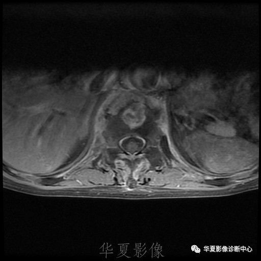 【病例】脊柱布氏杆菌病1例X线CT及MR 【病例】脊柱布氏杆菌病1例X线CT及MR