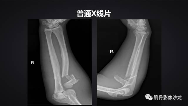 【病例】骨化性纤维瘤两例影像讨论 【病例】骨化性纤维瘤两例影像讨论