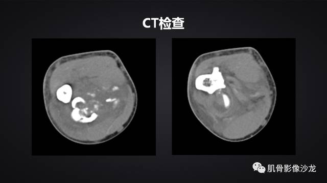 【病例】骨化性纤维瘤两例影像讨论 【病例】骨化性纤维瘤两例影像讨论