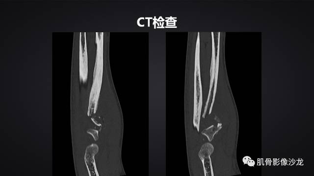 【病例】骨化性纤维瘤两例影像讨论 【病例】骨化性纤维瘤两例影像讨论