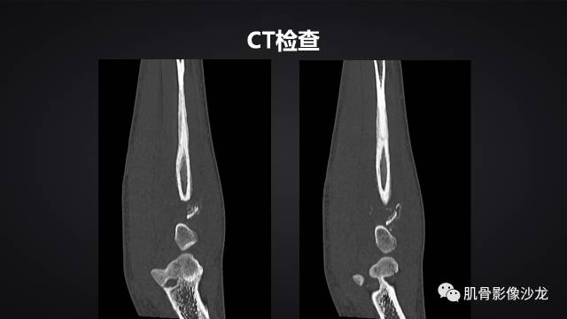 【病例】骨化性纤维瘤两例影像讨论 【病例】骨化性纤维瘤两例影像讨论