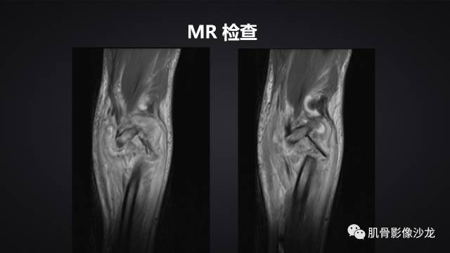 【病例】骨化性纤维瘤两例影像讨论 【病例】骨化性纤维瘤两例影像讨论