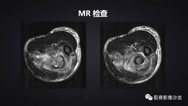 【病例】骨化性纤维瘤两例影像讨论 【病例】骨化性纤维瘤两例影像讨论