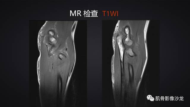 【病例】骨化性纤维瘤两例影像讨论 【病例】骨化性纤维瘤两例影像讨论