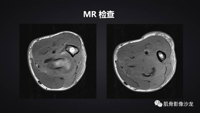 【病例】骨化性纤维瘤两例影像讨论 【病例】骨化性纤维瘤两例影像讨论