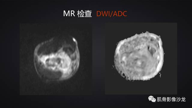 【病例】骨化性纤维瘤两例影像讨论 【病例】骨化性纤维瘤两例影像讨论